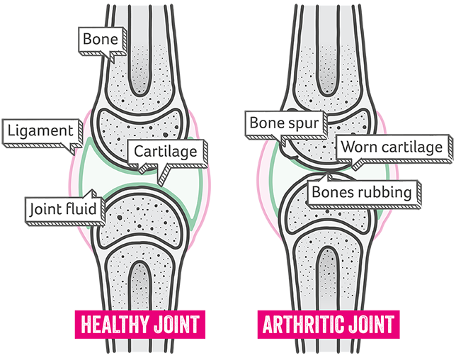 Illustration of a diagram showing a healthy joint and an arthritic joint side-by-side